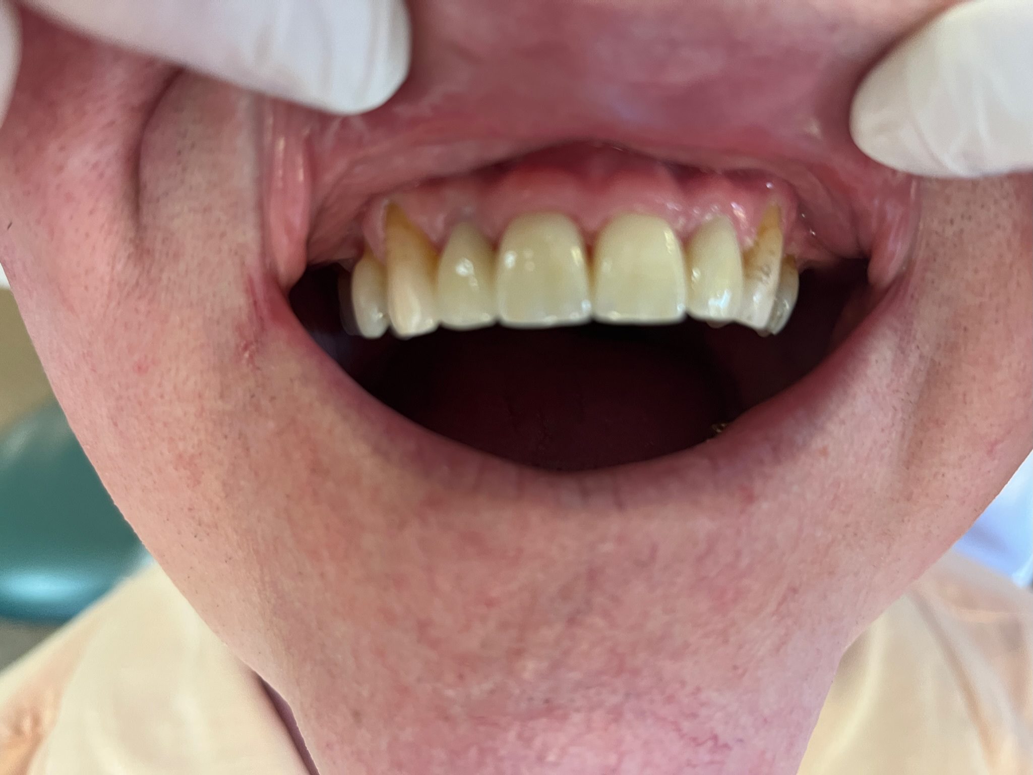4 Porcelain Crowns-after - Westport Family Dentistry