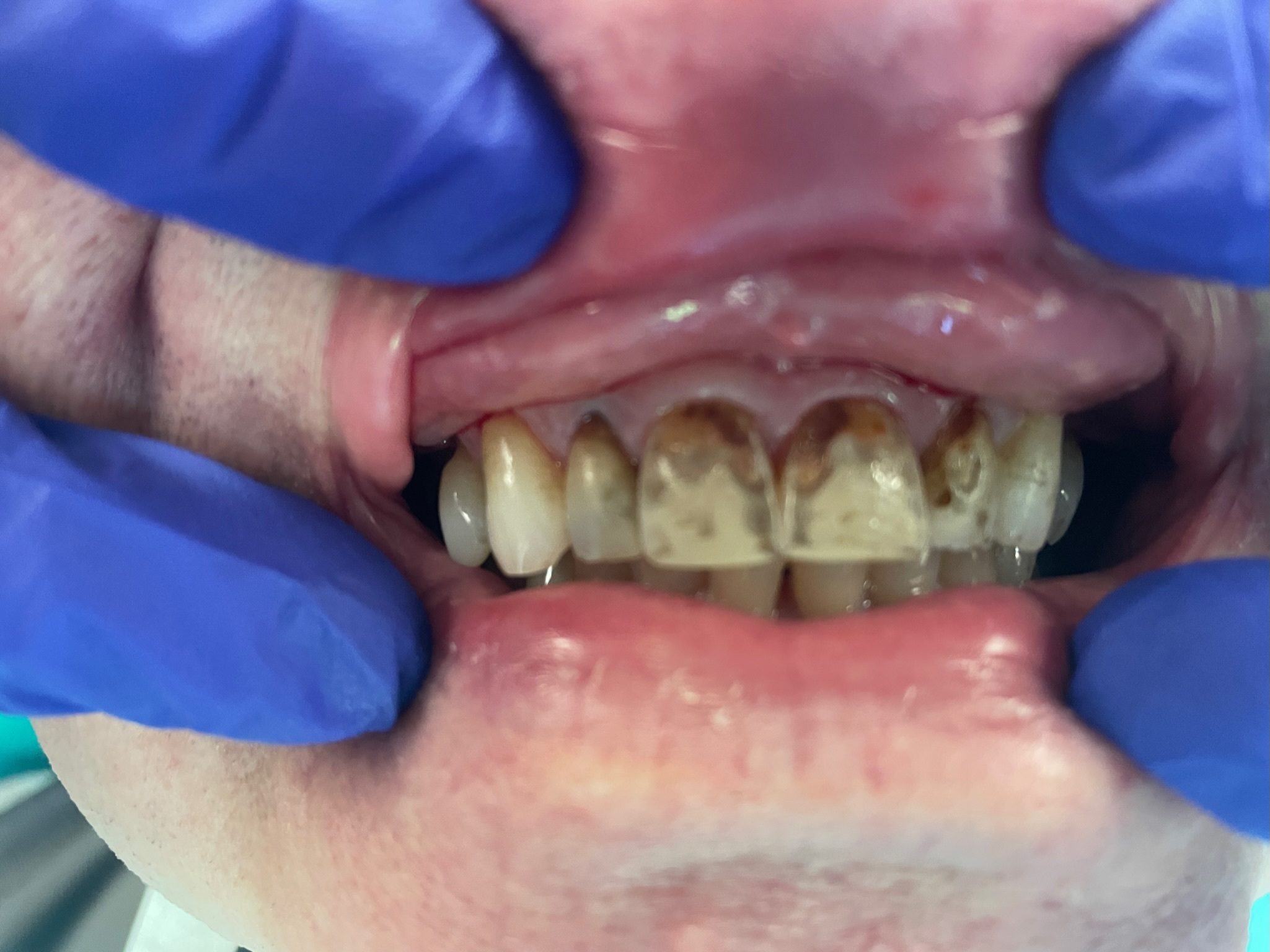4 Porcelain Crowns-before - Westport Family Dentistry
